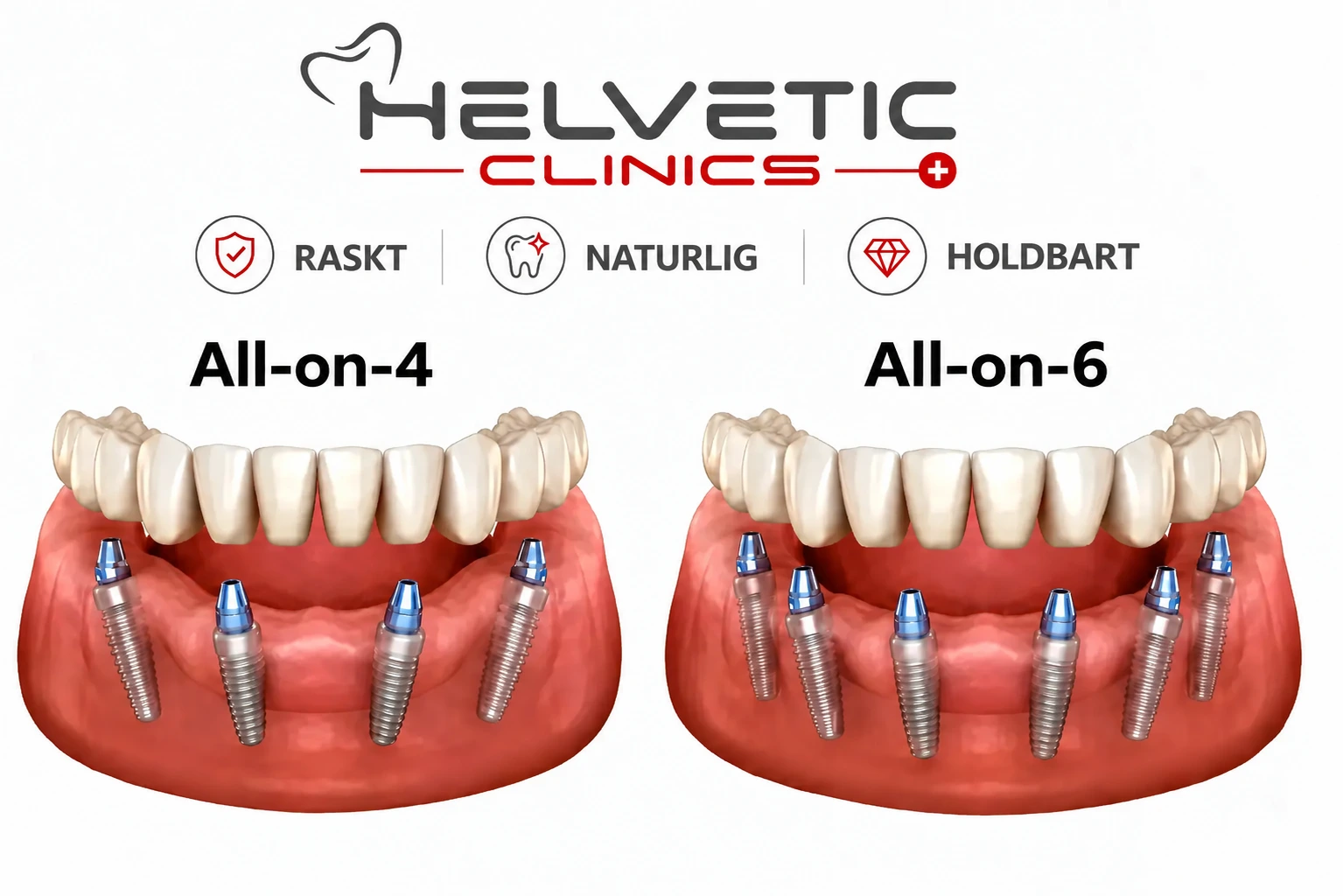 All-on-4 og All-on-6 tannimplantater med fire og seks implantater i underkjeven