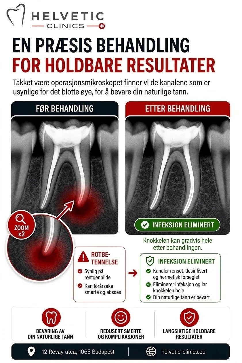 Røntgen-infografikk fra Helvetic Clinics Budapest som viser før og etter presis rotfylling, fjerning av rotbetennelse og bevaring av naturlig tann.