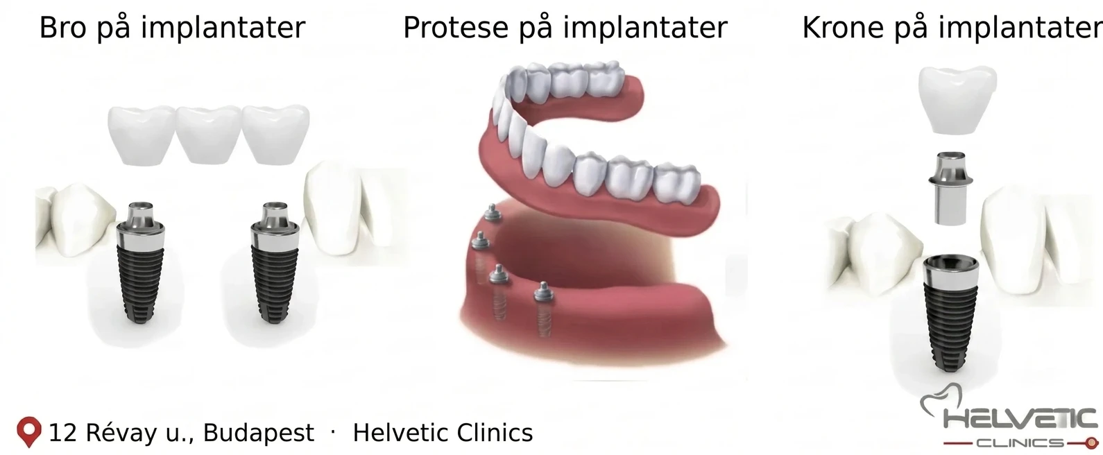 Ulike løsninger for tannimplantater som viser bro på implantater, protese på implantater og krone på implantater, utført hos Helvetic Clinics i Budapest.