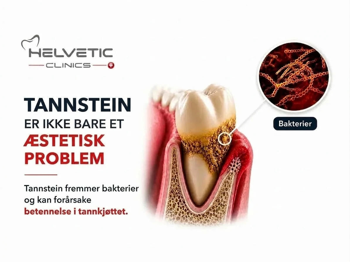 Illustrasjon av tannstein på en tann som fremmer bakterier og forårsaker tannkjøttbetennelse hos Helvetic Clinics Budapest