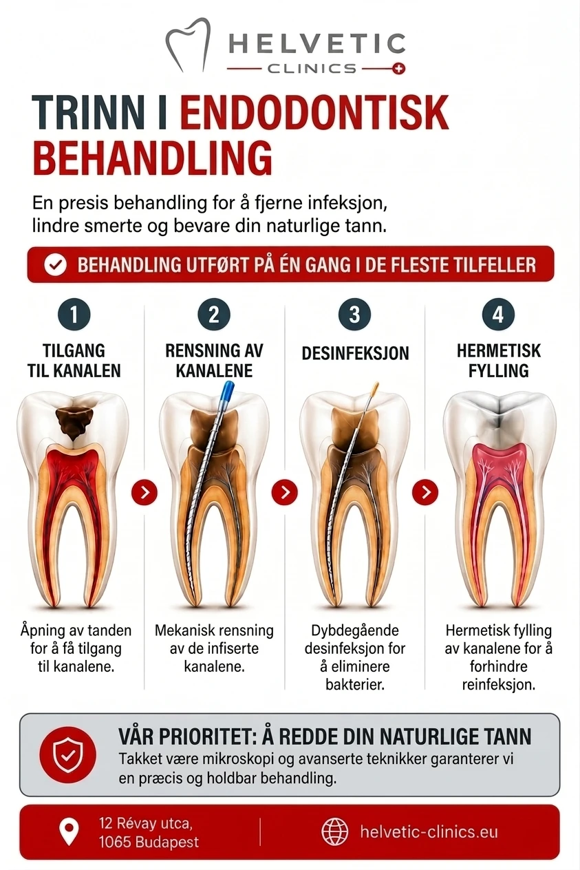 Infografikk fra Helvetic Clinics som viser de fire trinnene i endodontisk behandling for å redde den naturlige tannen: tilgang til kanalen, mekanisk rensning, dybdegående desinfeksjon og hermetisk fylling.